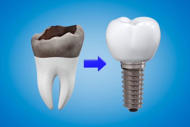 Weight loss after dental implant surgery